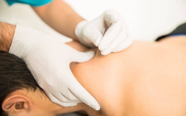 dry needling